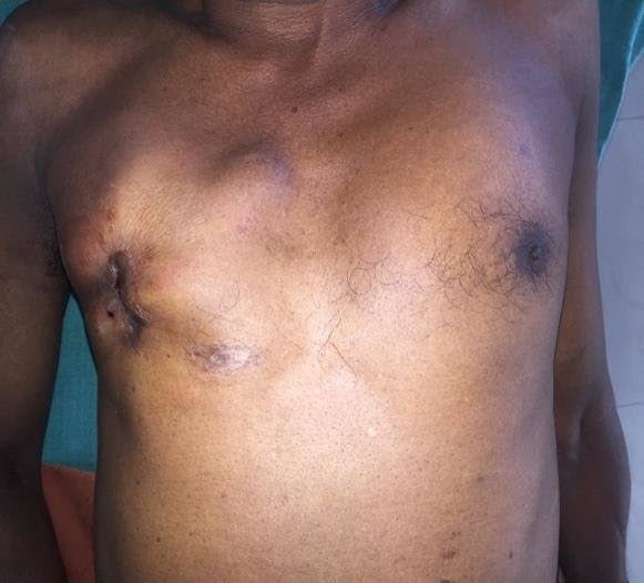 Saratani ya Matiti kwa Wanaume yaongezeka Tanzania